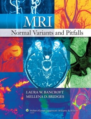 MRI Normal Variants and Pitfalls фото книги