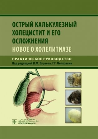 Острый калькулезный холецистит и его осложнения. Новое о холелитиазе фото книги