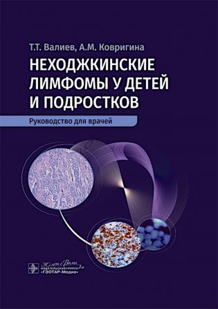 Неходжкинские лимфомы у детей и подростков: руководство для врачей фото книги